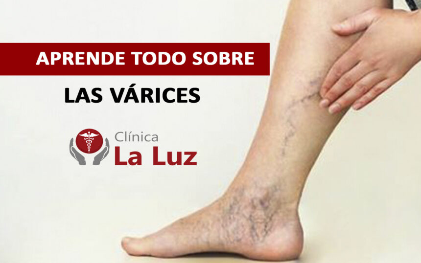 ¿Qué son las Várices? – Aprende con los especialistas