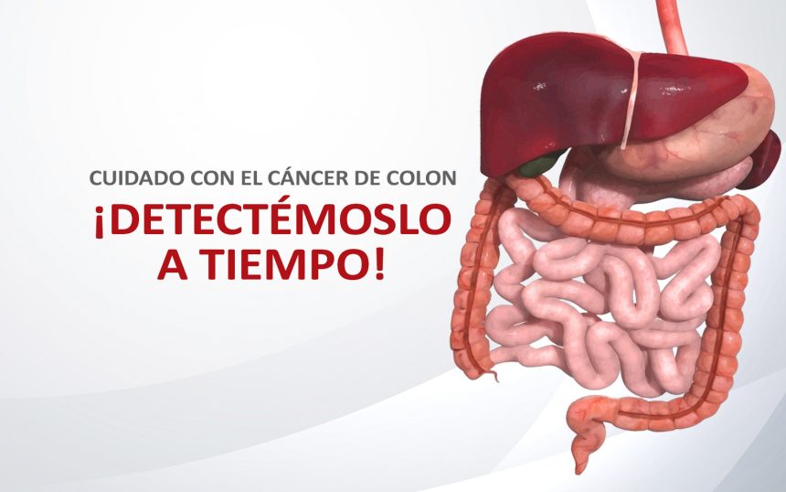 ¡Alerta! Cuidado con el Cáncer de Colon