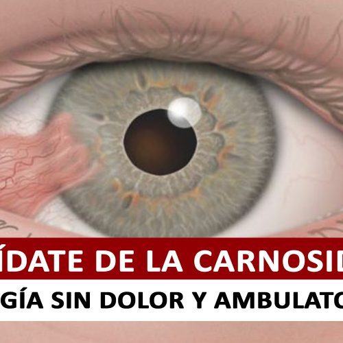 Pterigion – Síntomas, causas y cirugía