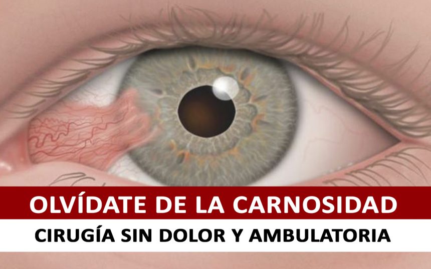 Pterigion – Síntomas, causas y cirugía