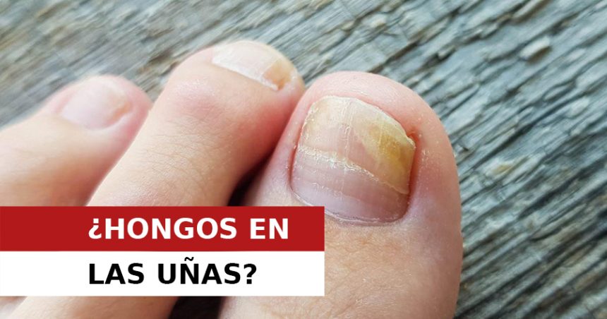 ONICOMICOSIS: El enemigo de tu pies en verano. ONICOMICOSIS: El enemigo de tu pies en verano.